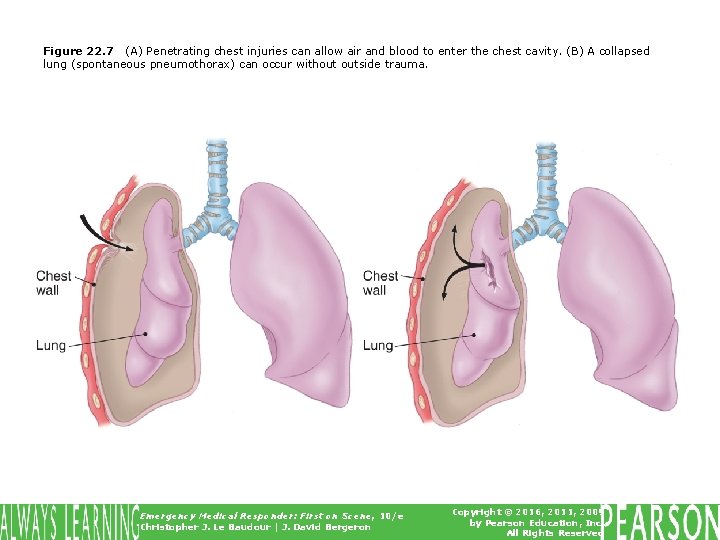 Figure 22. 7 (A) Penetrating chest injuries can allow air and blood to enter