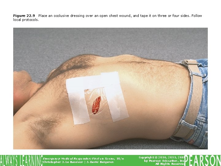 Figure 22. 9 Place an occlusive dressing over an open chest wound, and tape