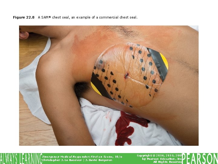 Figure 22. 8 A SAM® chest seal, an example of a commercial chest seal.