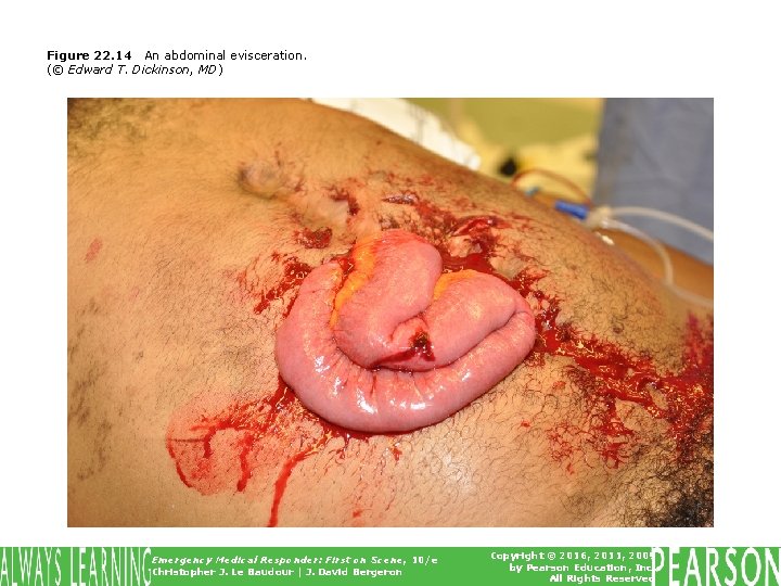 Figure 22. 14 An abdominal evisceration. (© Edward T. Dickinson, MD) Emergency Medical Responder: