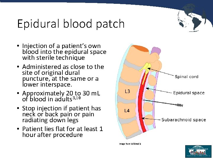 Epidural blood patch • Injection of a patient’s own blood into the epidural space