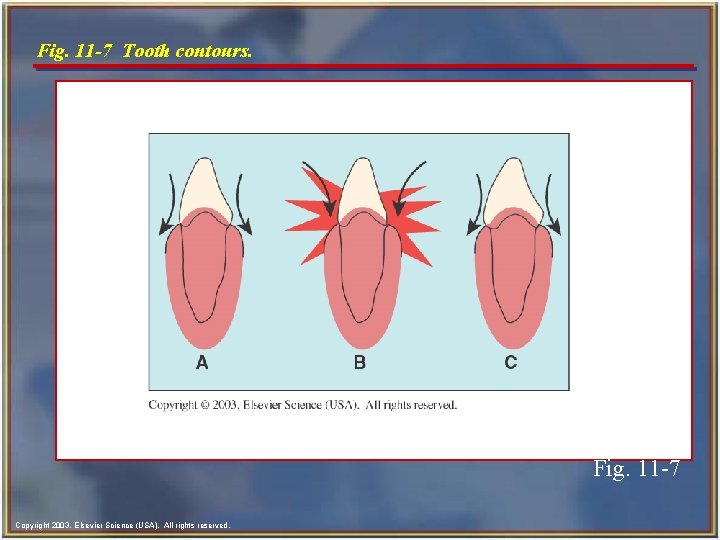 Fig. 11 -7 Tooth contours. Fig. 11 -7 Copyright 2003, Elsevier Science (USA). All