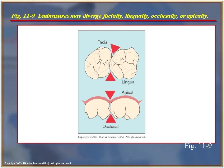 Fig. 11 -9 Embrasures may diverge facially, lingually, occlusally, or apically. Fig. 11 -9