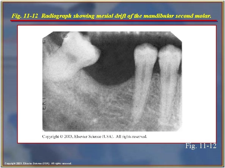 Fig. 11 -12 Radiograph showing mesial drift of the mandibular second molar. Fig. 11