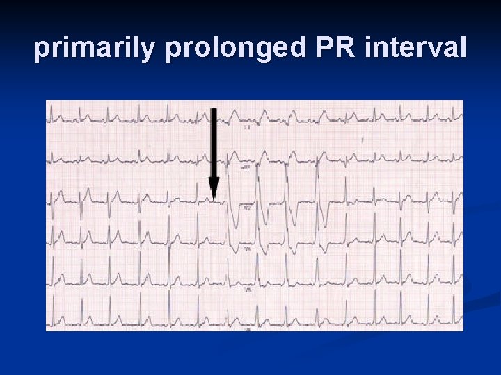 primarily prolonged PR interval 