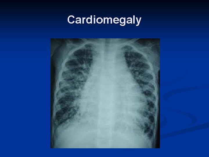 Cardiomegaly 