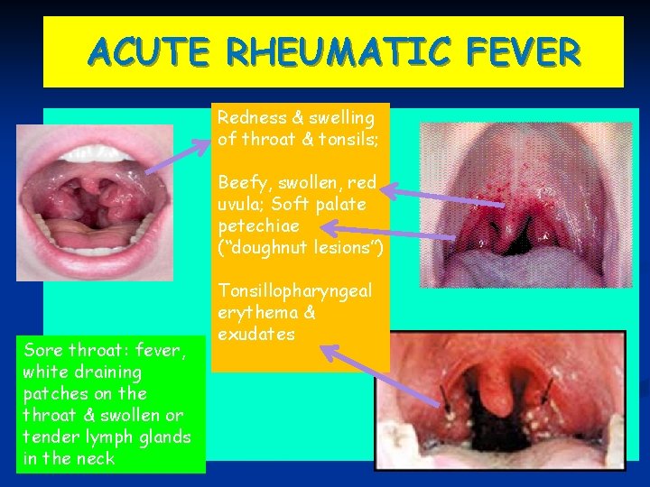 ACUTE RHEUMATIC FEVER Redness & swelling of throat & tonsils; Beefy, swollen, red uvula;