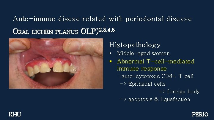 Auto-immue diseae related with periodontal disease ORAL LICHEN PLANUS (OLP)2, 3, 4, 5 Histopathology