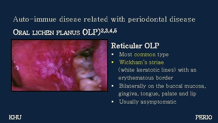 Auto-immue diseae related with periodontal disease ORAL LICHEN PLANUS (OLP)2, 3, 4, 5 Reticular