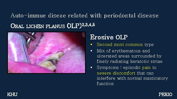 Auto-immue diseae related with periodontal disease ORAL LICHEN PLANUS (OLP)2, 3, 4, 5 Erosive