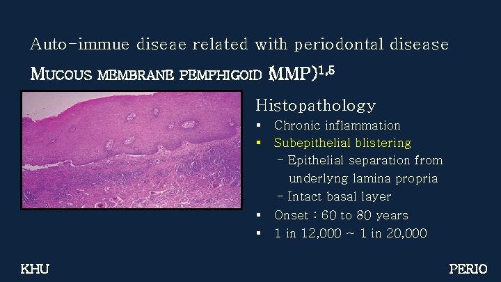 Auto-immue diseae related with periodontal disease MUCOUS MEMBRANE PEMPHIGOID (MMP)1, 5 Histopathology § §