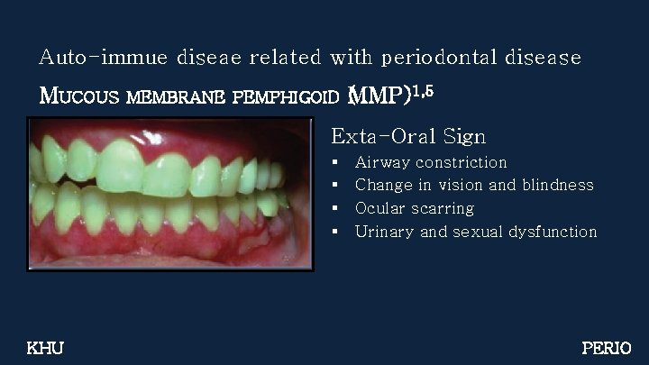 Auto-immue diseae related with periodontal disease MUCOUS MEMBRANE PEMPHIGOID (MMP)1, 5 Exta-Oral Sign §