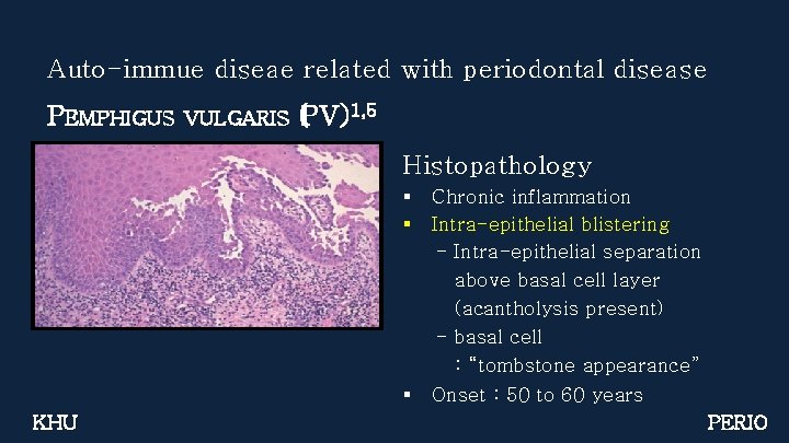 Auto-immue diseae related with periodontal disease PEMPHIGUS VULGARIS (PV)1, 5 Histopathology § § §