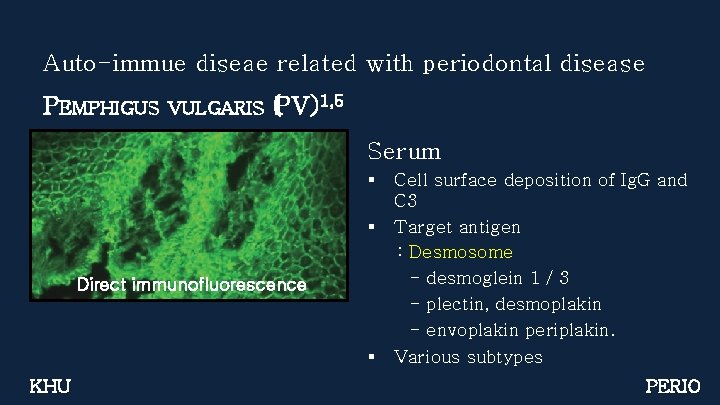 Auto-immue diseae related with periodontal disease PEMPHIGUS VULGARIS (PV)1, 5 Serum § § Direct