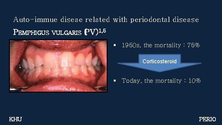 Auto-immue diseae related with periodontal disease PEMPHIGUS VULGARIS (PV)1, 5 § 1950 s, the