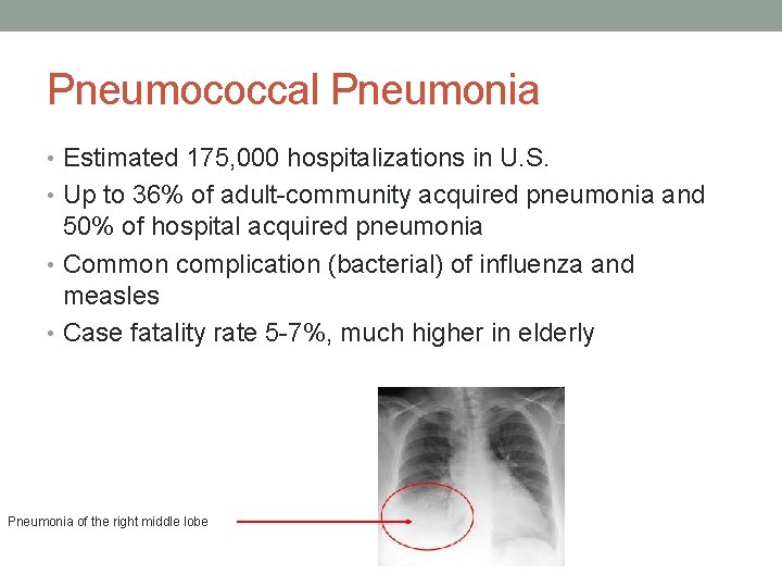 Pneumococcal Pneumonia • Estimated 175, 000 hospitalizations in U. S. • Up to 36%