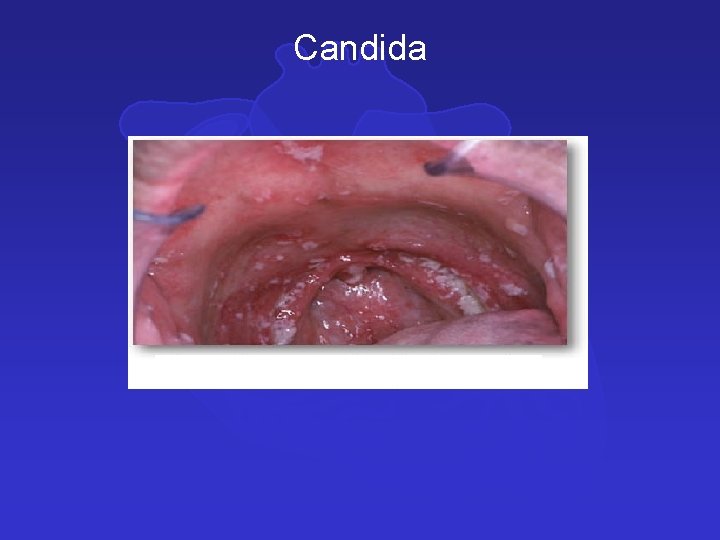 Candida 