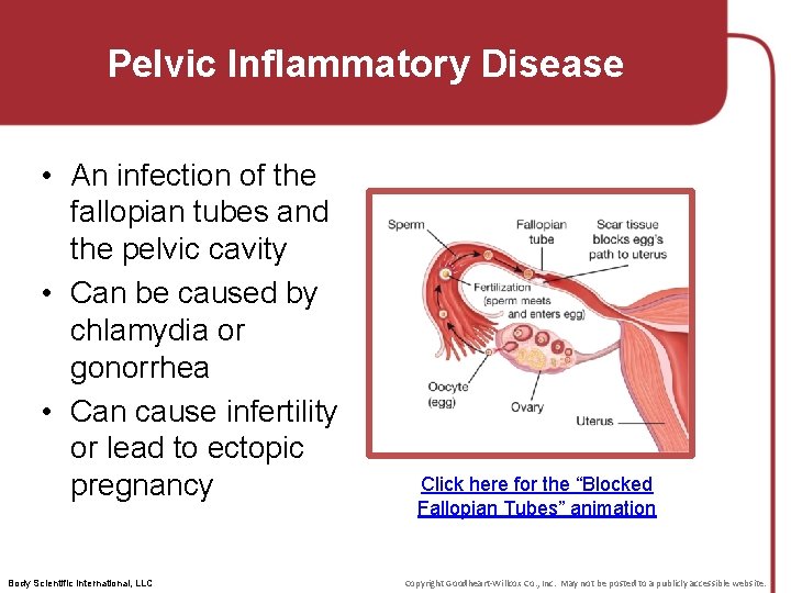 Pelvic Inflammatory Disease • An infection of the fallopian tubes and the pelvic cavity