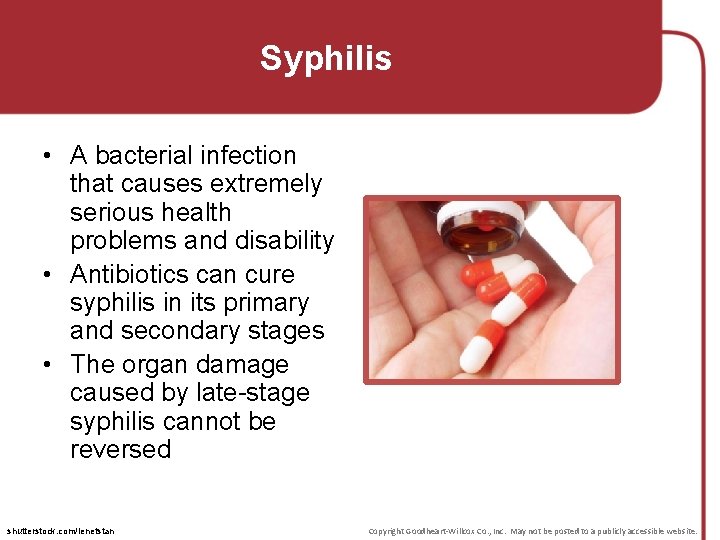 Syphilis • A bacterial infection that causes extremely serious health problems and disability •