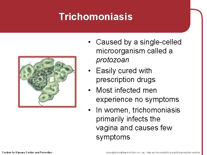 Trichomoniasis • Caused by a single-celled microorganism called a protozoan • Easily cured with