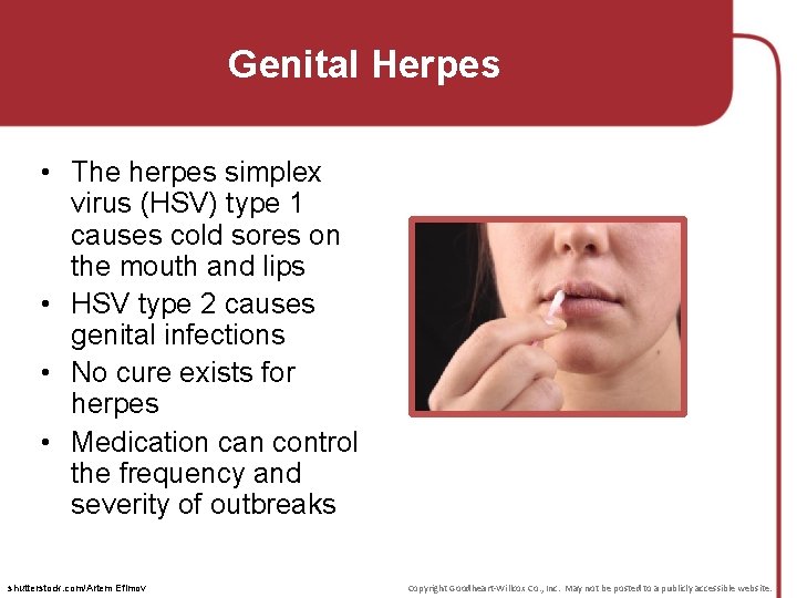 Genital Herpes • The herpes simplex virus (HSV) type 1 causes cold sores on Genital Herpes • The herpes simplex virus (HSV) type 1 causes cold sores on