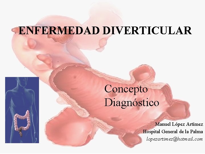 ENFERMEDAD DIVERTICULAR Concepto Diagnóstico Manuel López Artímez Hospital General de la Palma lopezartimez@hotmail. com