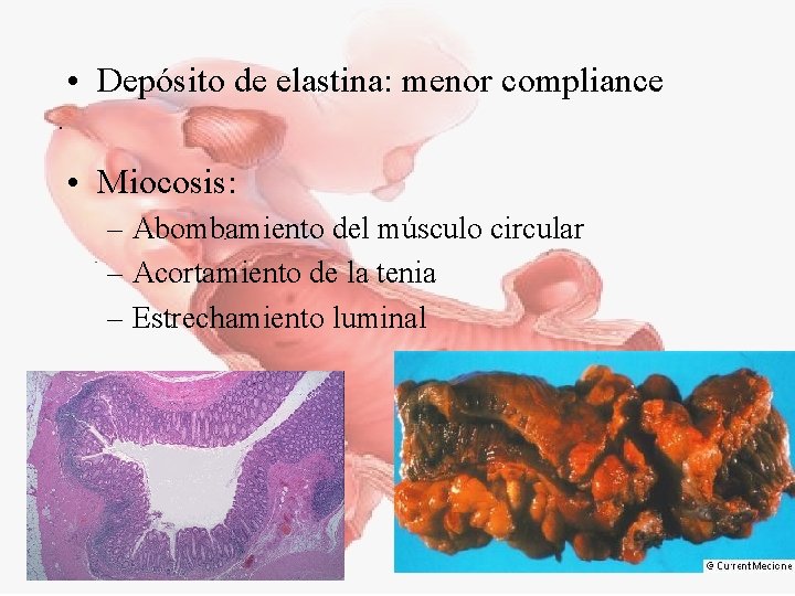  • Depósito de elastina: menor compliance • Miocosis: – Abombamiento del músculo circular