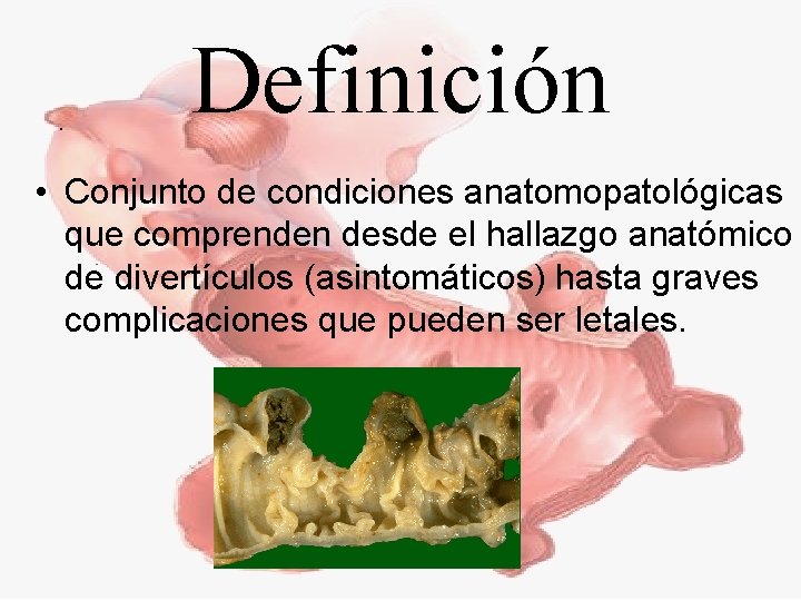 Definición • Conjunto de condiciones anatomopatológicas que comprenden desde el hallazgo anatómico de divertículos