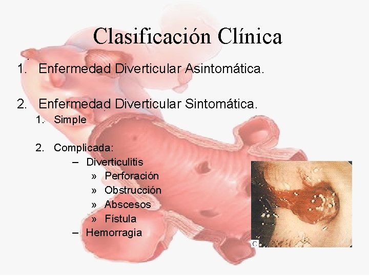 Clasificación Clínica 1. Enfermedad Diverticular Asintomática. 2. Enfermedad Diverticular Sintomática. 1. Simple 2. Complicada: