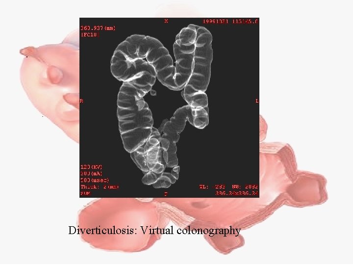 Diverticulosis: Virtual colonography 