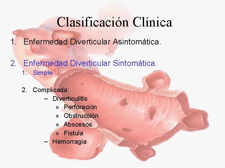 Clasificación Clínica 1. Enfermedad Diverticular Asintomática. 2. Enfermedad Diverticular Sintomática. 1. Simple 2. Complicada: