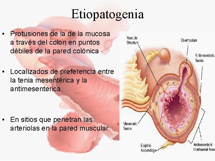 Etiopatogenia • Protusiones de la mucosa a través del colon en puntos débiles de