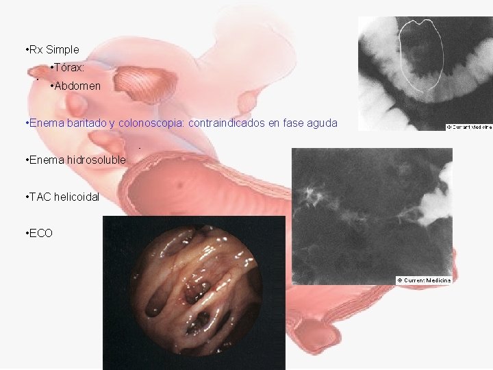  • Rx Simple • Tórax: • Abdomen • Enema baritado y colonoscopia: contraindicados