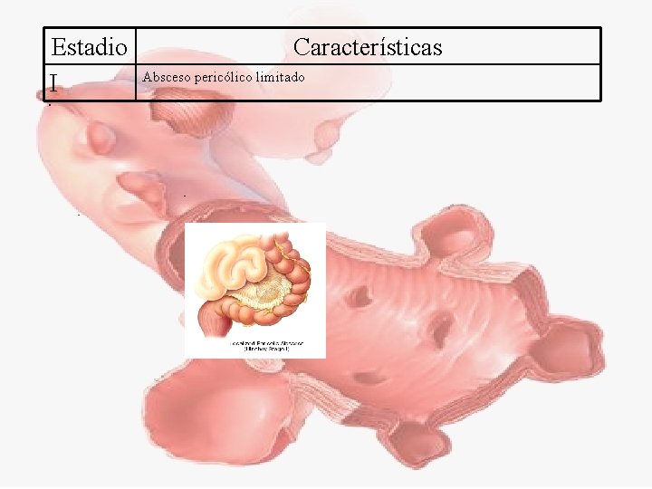 Estadio I Características Absceso pericólico limitado 