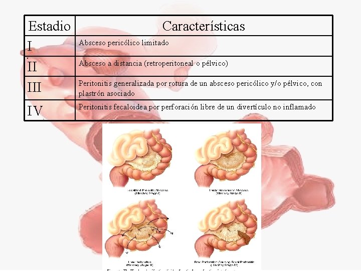 Estadio I II IV Características Absceso pericólico limitado Absceso a distancia (retroperitoneal o pélvico)