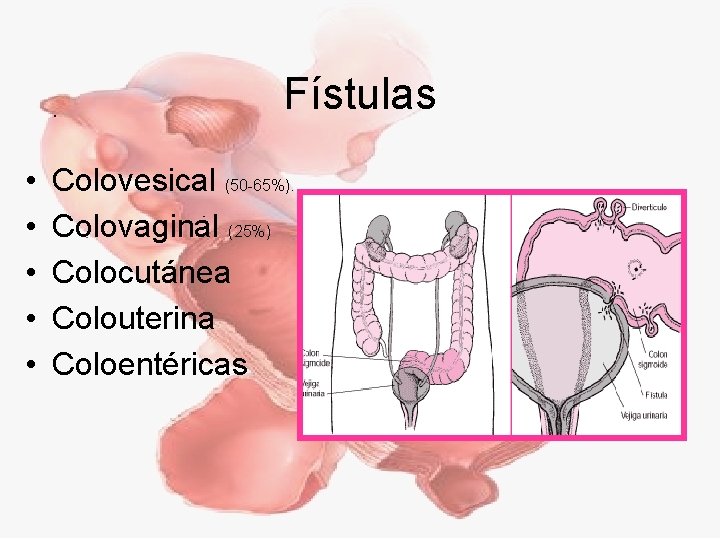 Fístulas • • • Colovesical (50 -65%). Colovaginal (25%) Colocutánea Colouterina Coloentéricas 