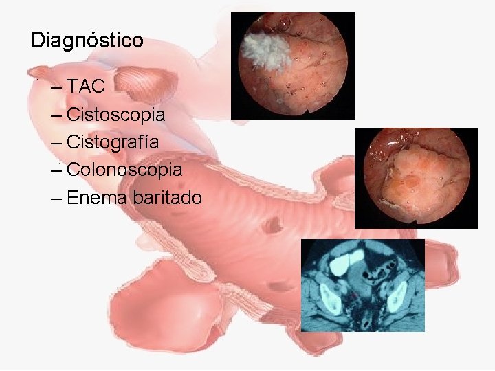 Diagnóstico – TAC – Cistoscopia – Cistografía – Colonoscopia – Enema baritado 