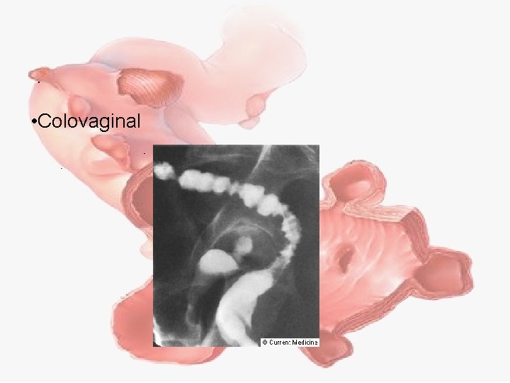  • Colovaginal 