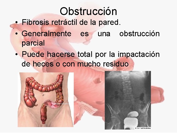 Obstrucción • Fibrosis retráctil de la pared. • Generalmente es una obstrucción parcial •