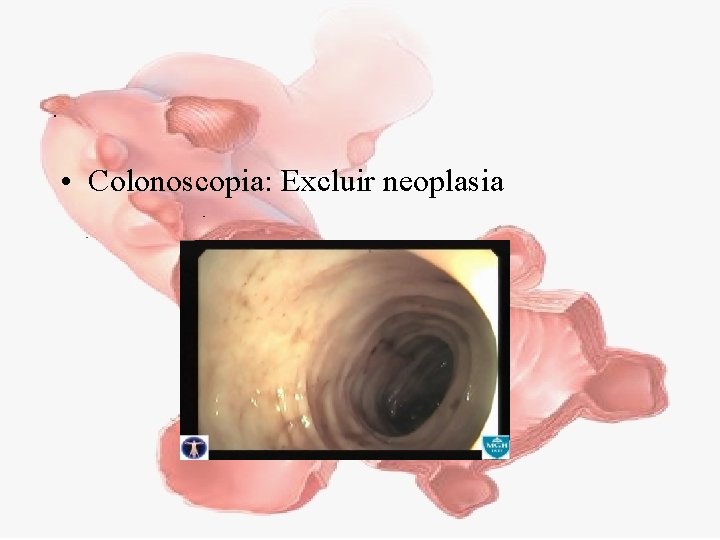  • Colonoscopia: Excluir neoplasia 