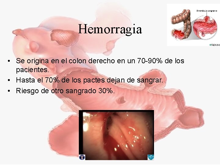Hemorragia • Se origina en el colon derecho en un 70 -90% de los