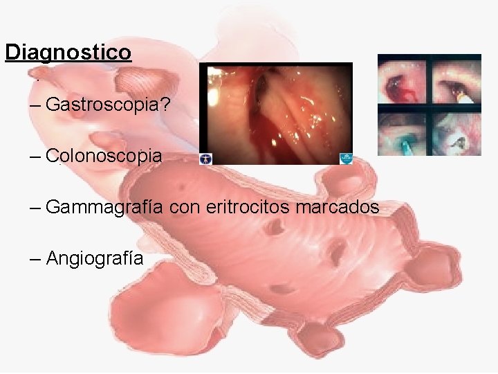 Diagnostico – Gastroscopia? – Colonoscopia – Gammagrafía con eritrocitos marcados – Angiografía 