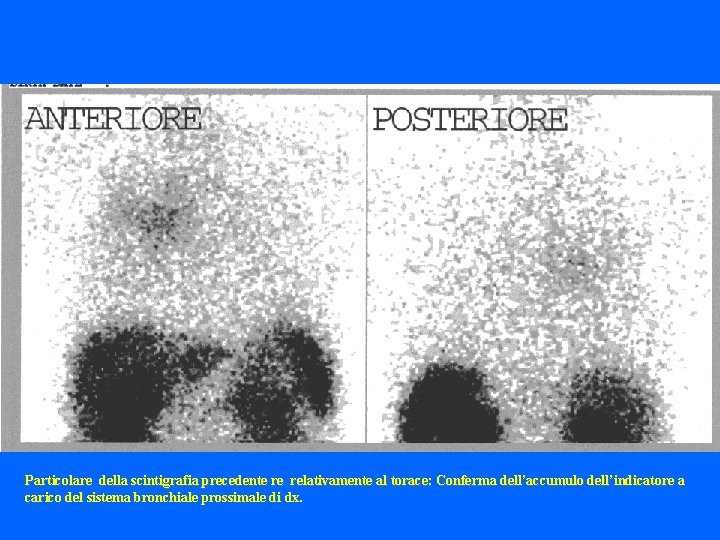 Particolare della scintigrafia precedente re relativamente al torace: Conferma dell’accumulo dell’indicatore a carico del