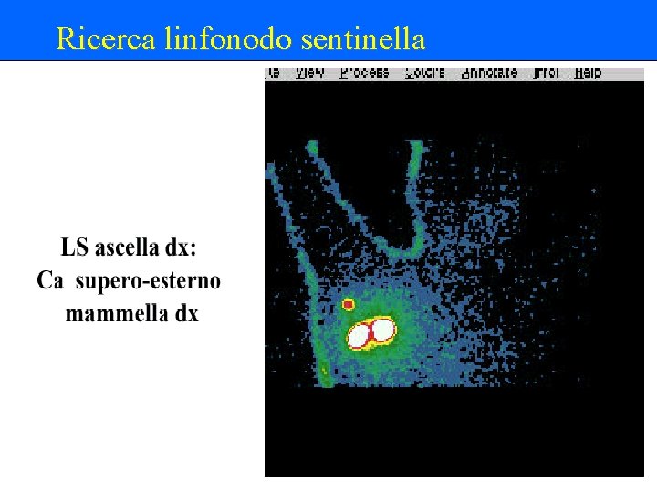 Ricerca linfonodo sentinella 