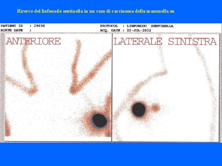 Ricerce del linfonodo sentinella in un caso di carcinoma della mammella sn 