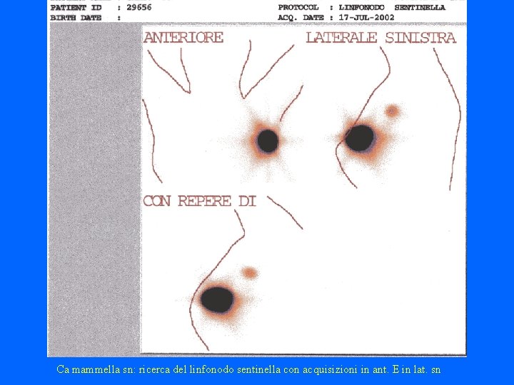Ca mammella sn: ricerca del linfonodo sentinella con acquisizioni in ant. E in lat.