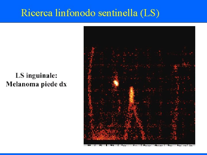 Ricerca linfonodo sentinella (LS) 