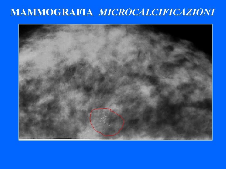 MAMMOGRAFIA MICROCALCIFICAZIONI 