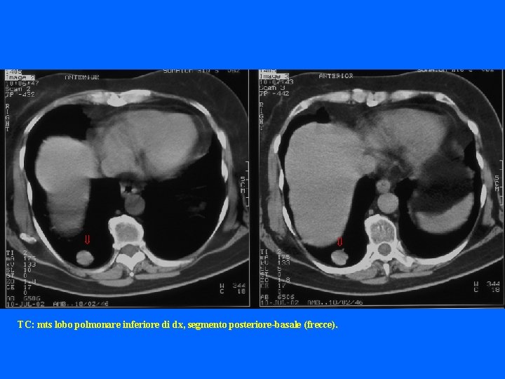 TC: mts lobo polmonare inferiore di dx, segmento posteriore-basale (frecce). 