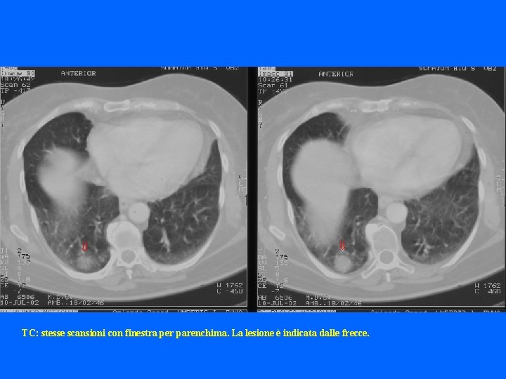  TC: stesse scansioni con finestra per parenchima. La lesione è indicata dalle frecce.